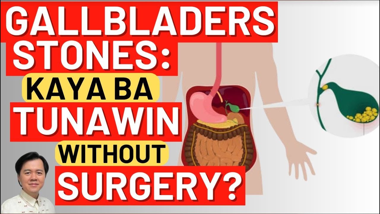 Gallbladders Stones: Kaya Ba Tunawin Without Surgery? By Doc Willie Ong and Dr Roel Tolentino
