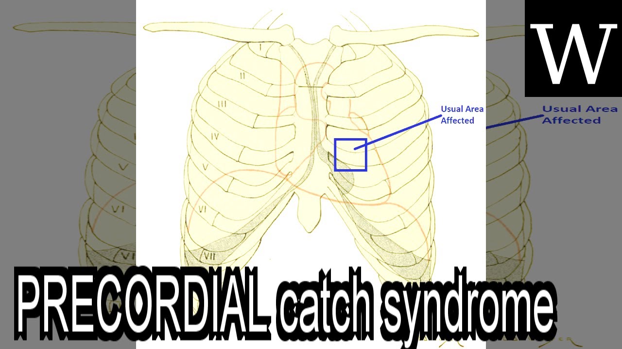 PRECORDIAL catch syndrome - WikiVidi Documentary