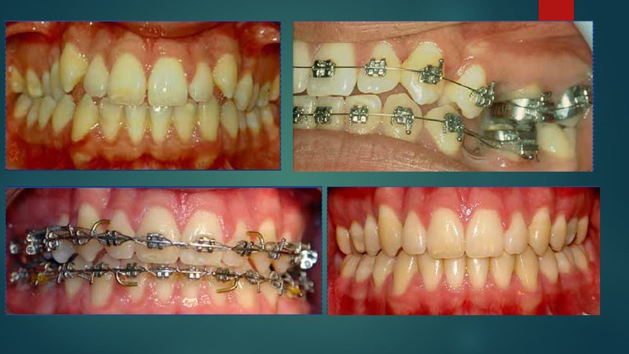 Severe Dental Crowding!!! Orthodontics!!