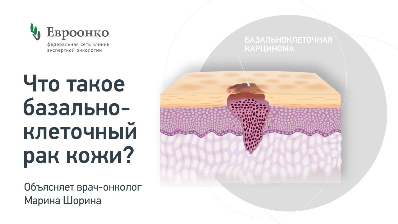 Насколько опасен базальноклеточный рак кожи? Как его лечат? Рассказывает врач-онколог Марина Шорина