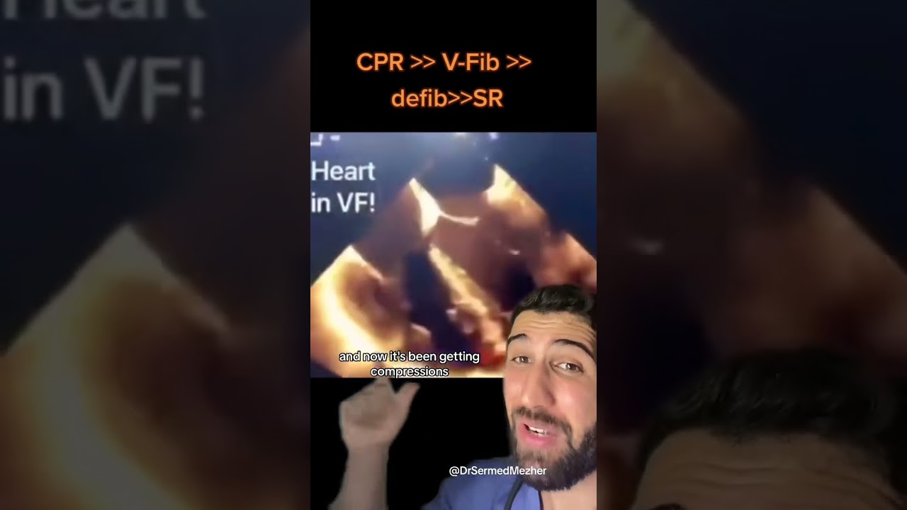 What the Heart Actually Looks Like During a Cardiac Arrest #medicine