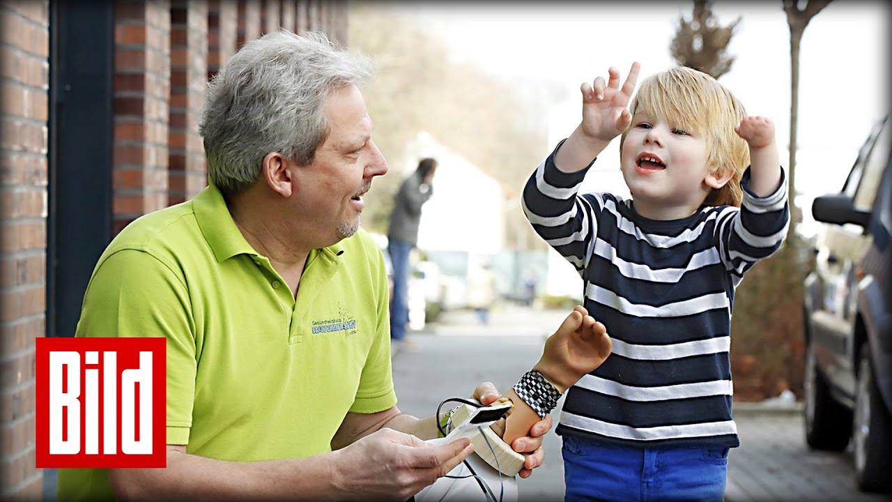 Junge (4) übt mit neuer Hand-Prothese -  Orthopädie-Handwerk / Amputation