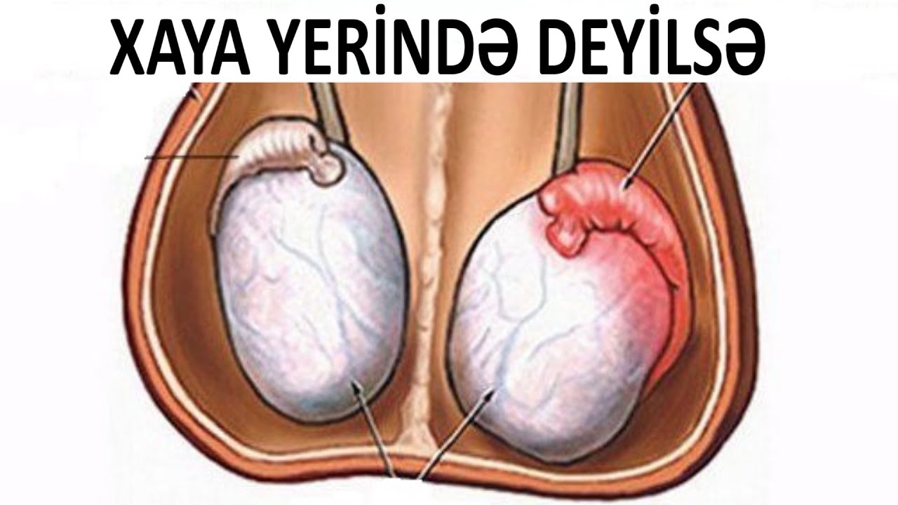 Uşağınızda xaya yerində yoxdursa - Mütləq izləyin!