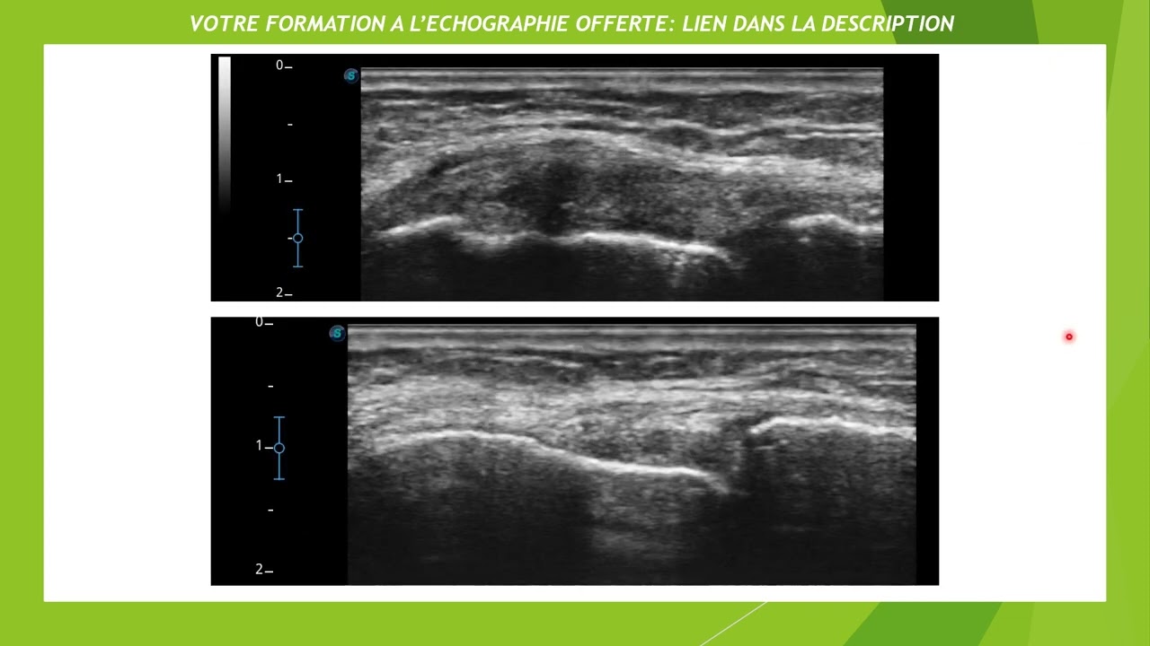 Echographie d'une entorse m&eacute;diale du genou
