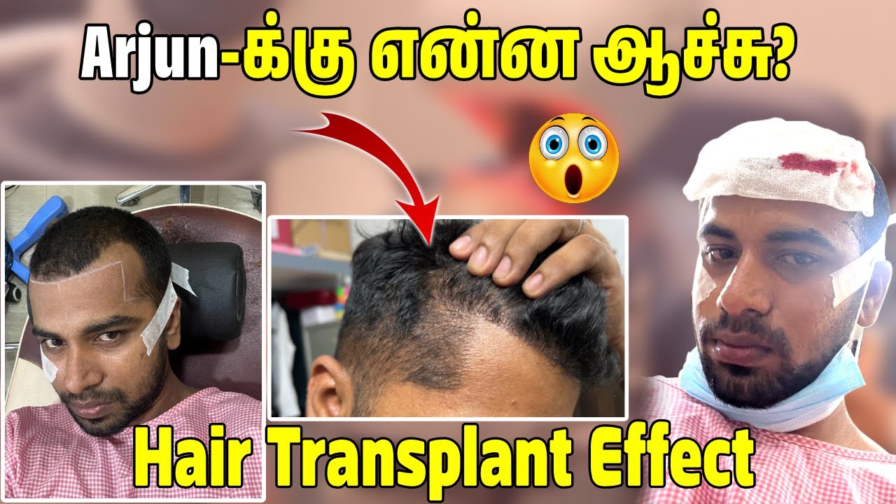 Arjun-க்கு என்ன ஆச்சு?😮 | 6 Months கழிச்சு Hair Transplant நிலைமை | JUUJEE Vlogs
