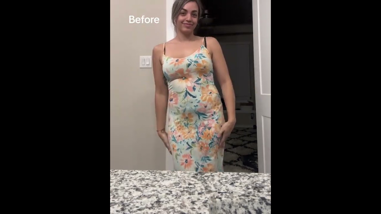 When I Get My Body Done... | Dr. William | BBL Results #miamiplasticsurgery #bbl #drwilliammiami