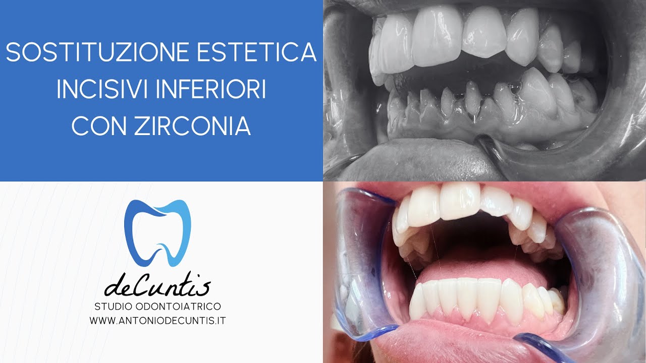 Sostituzione Estetica Incisivi Inferiori con Zirconia (metal free) - Dott. Antonio de Cuntis