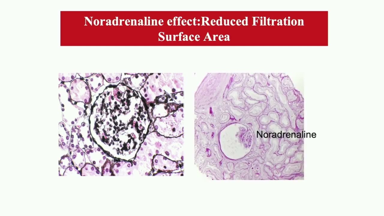 A. Santoro - Cuore e malattia renale cronica #cardiologia