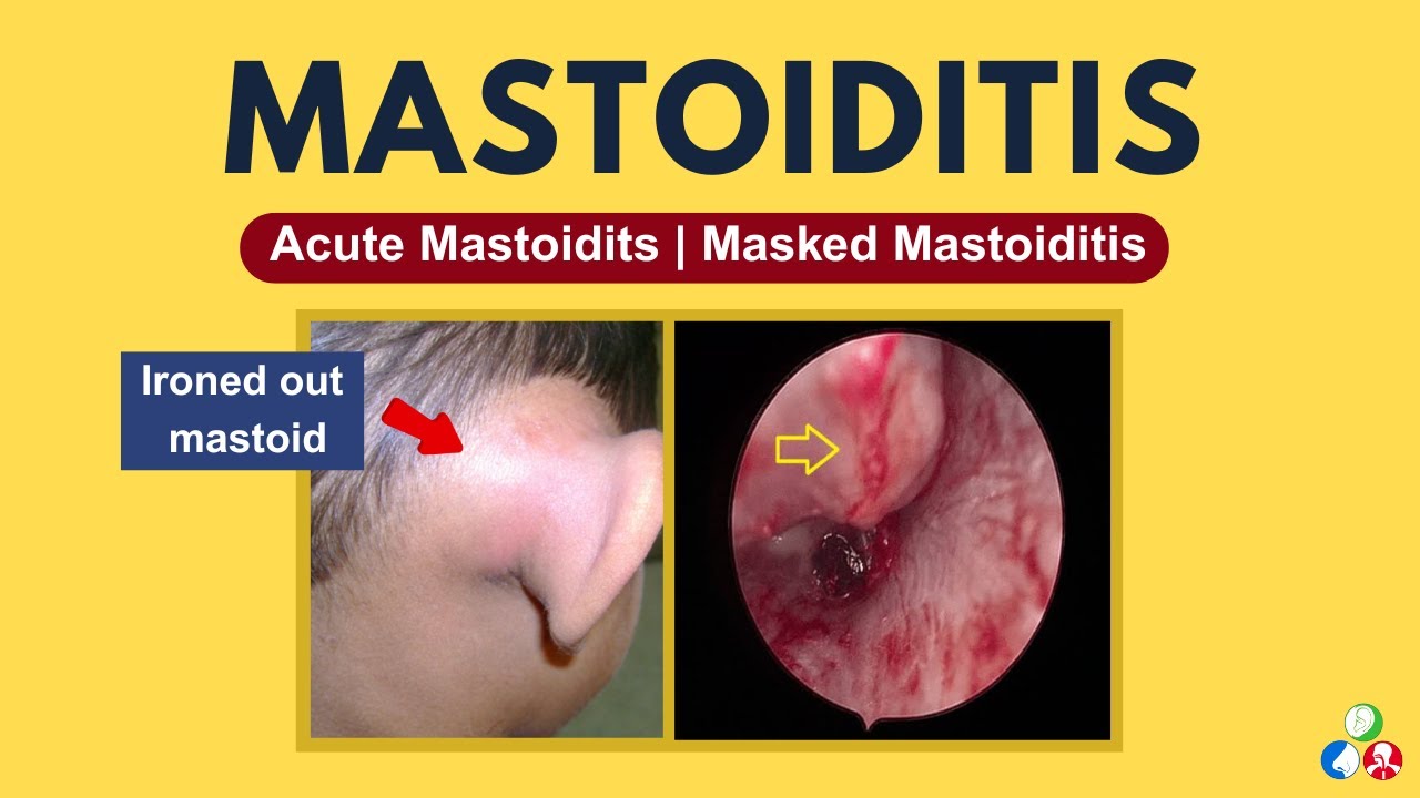 Mastoiditis | Causes, Symptoms, Treatment
