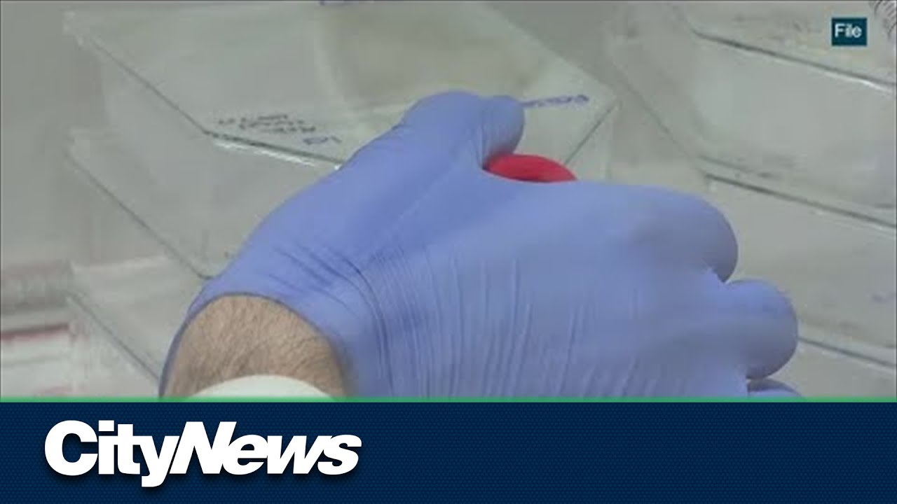 Alberta labs short on urinalysis tests