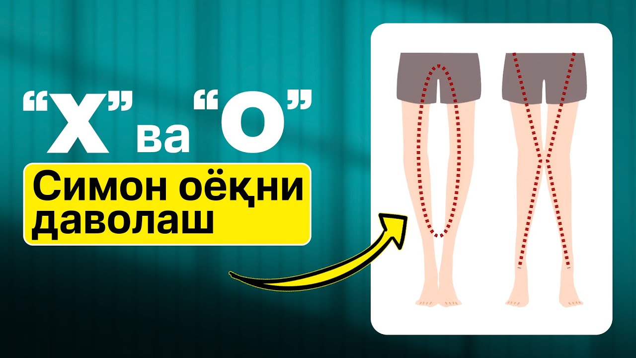 X va O shaklidagi oyoqlarni qanday to‘g‘rilash mumkin ?