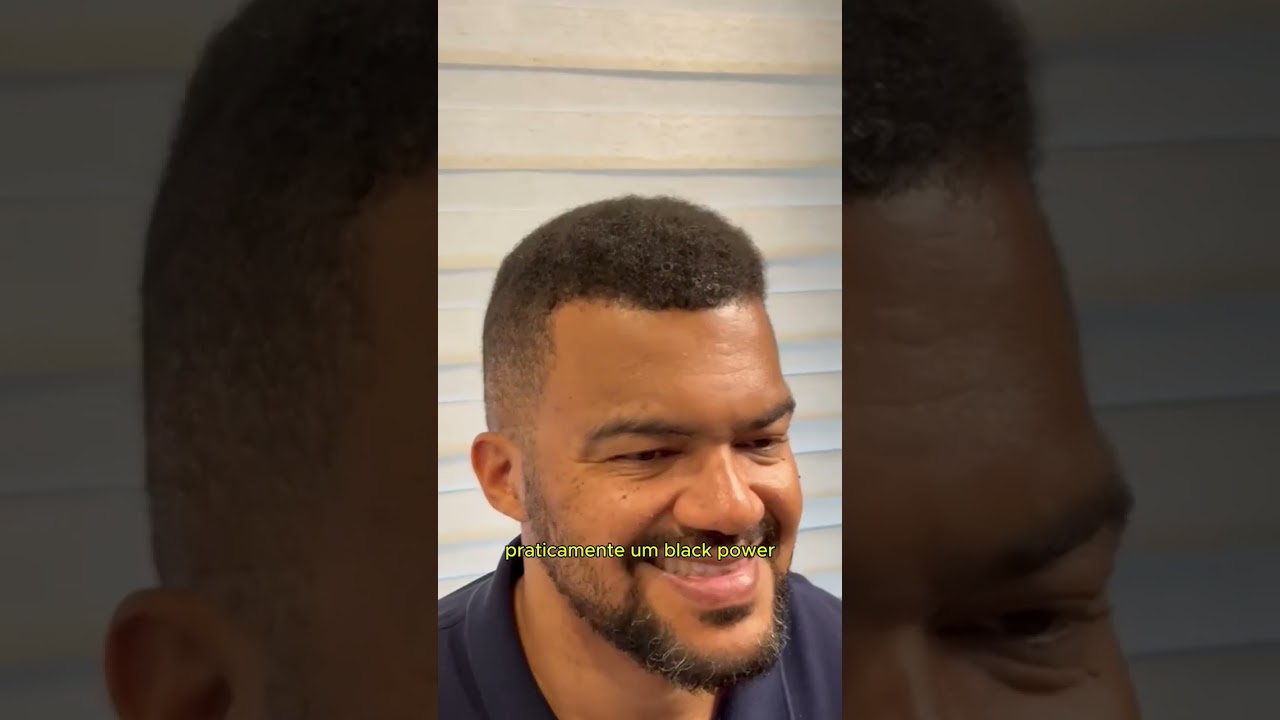 Resultado de transplante capilar em cabelo afro após 6 meses