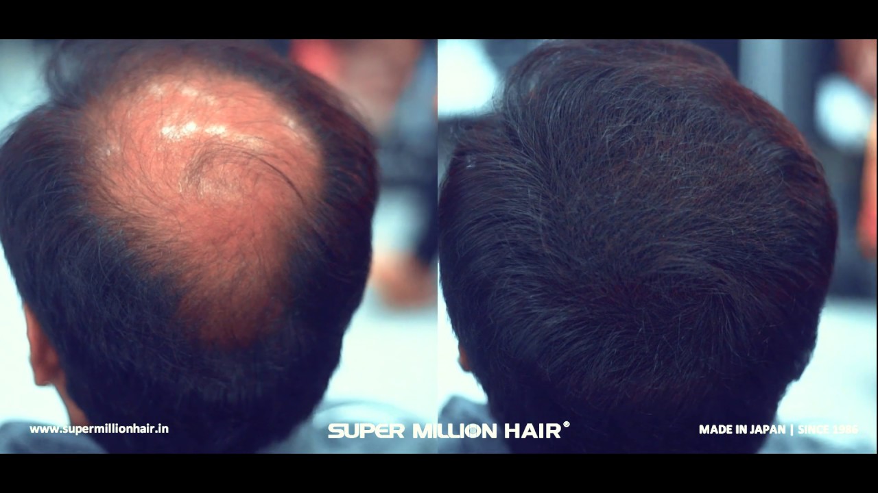 Super Million Hair - Boosting Confidence Since 1986