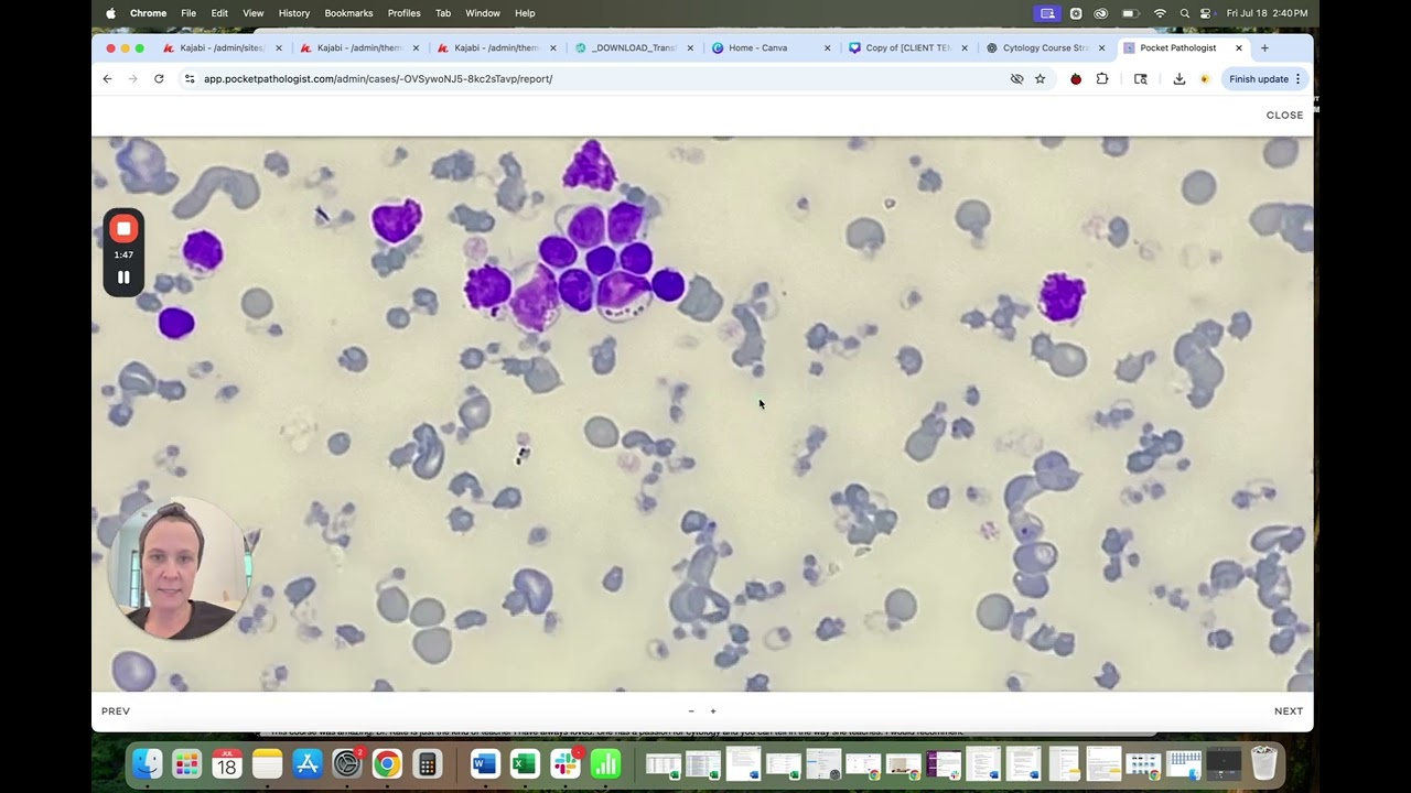 Severe Heinz body anemia and ghost RBCs in a cat blood smear