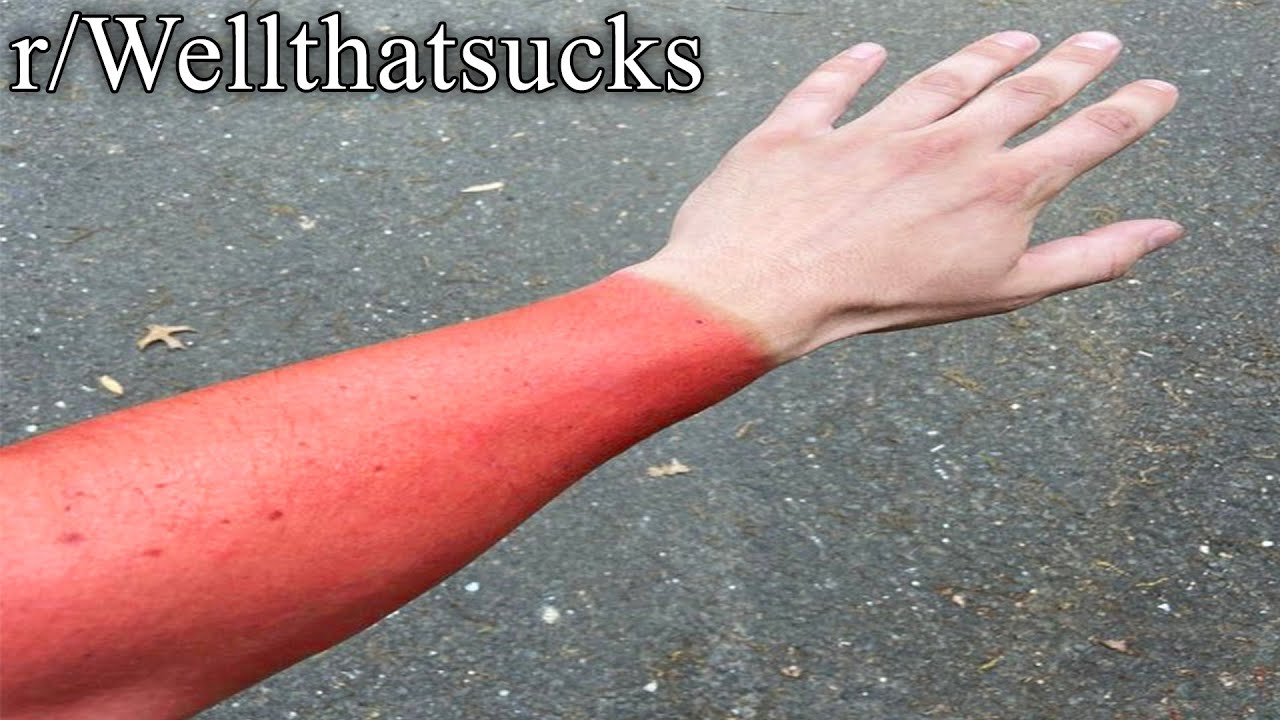 r/Wellthatsucks | ouch