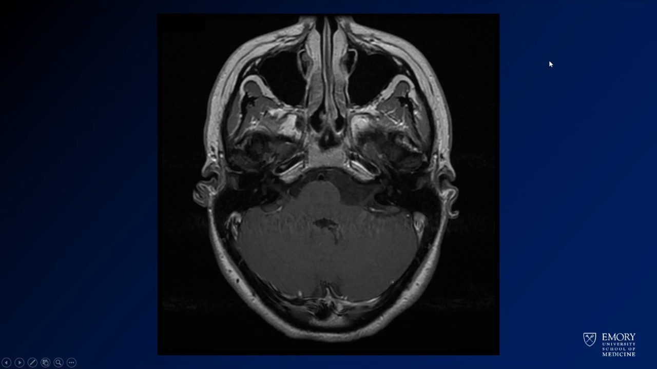 Neuroradiology board review lecture 1 case 17