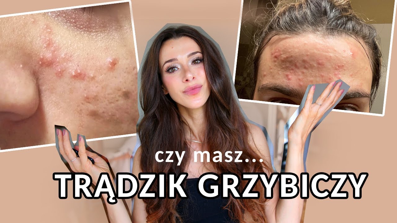 TWÓJ TRĄDZIK NIE ZNIKA? To może być trądzik grzybiczy!
