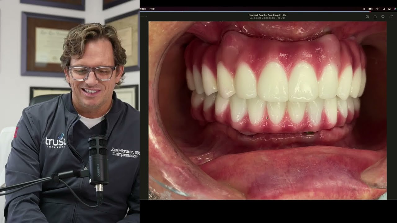 Optimizing Dental Health: Insights on Bite Dynamics & Prosthetics by Dr. Willardsen