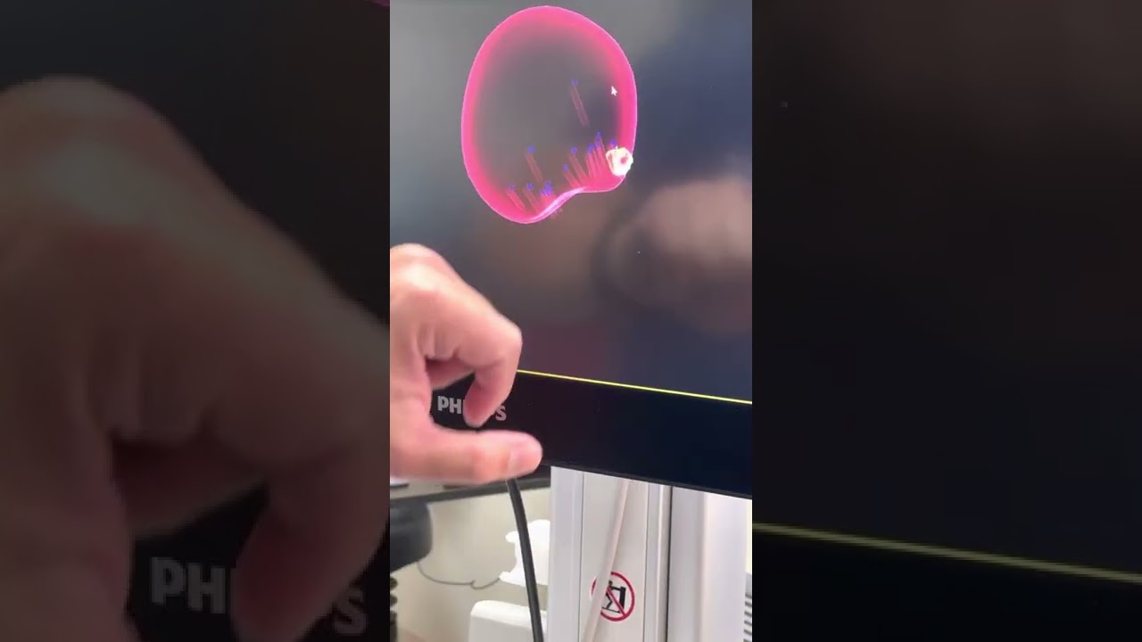 UroNav Transperineal MRI-US fusion biopsy