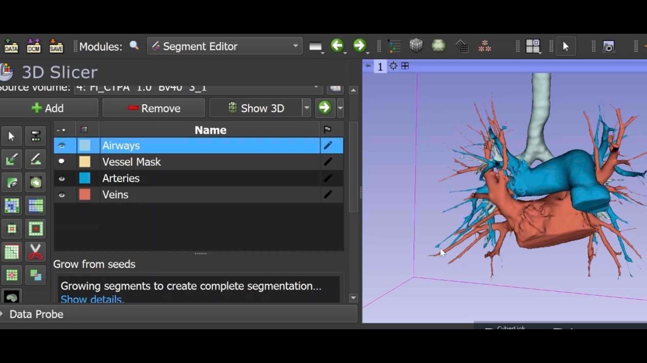 3D Reconstruction of Pulmonary broncho-vascular anatomy using 3D Slicer