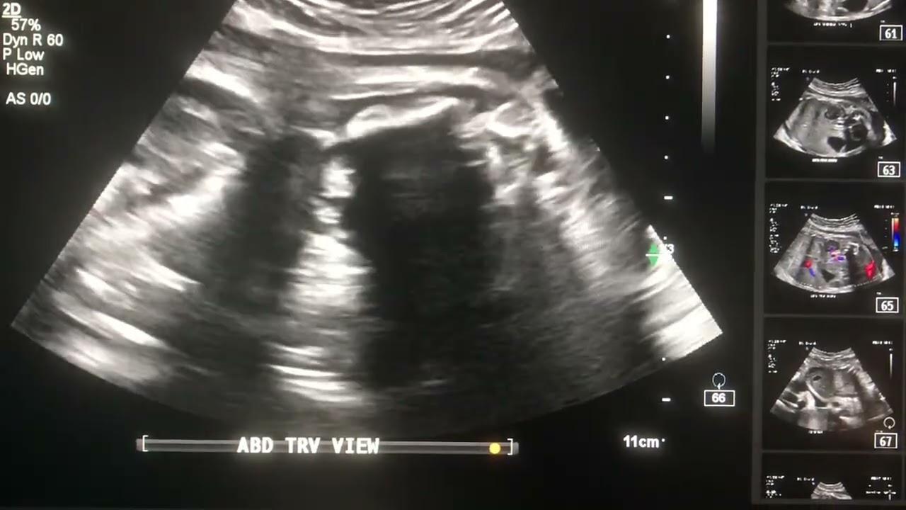 interesting case 61- OB US - Absent LT KID. & a Cyst