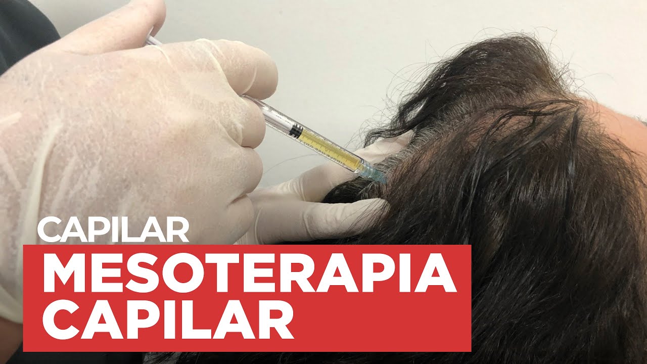 Mesoterapia capilar · Qué es y cómo funciona · Instituto Médico Ricart