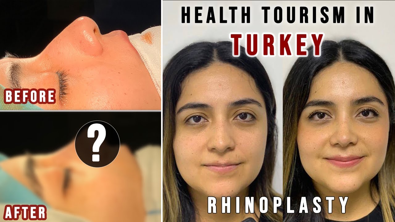 Rhinoplasty in Turkey - FULL EXPERIENCE | Affordable and Good Quality (HEALTH TOURISM IN TURKEY)