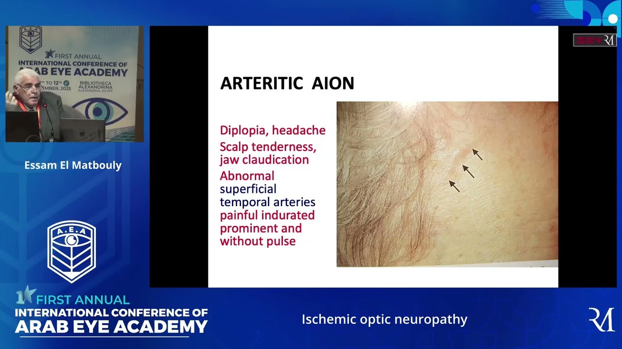 Ischemic optic neuropathy, Dr. Essam El Matbouly