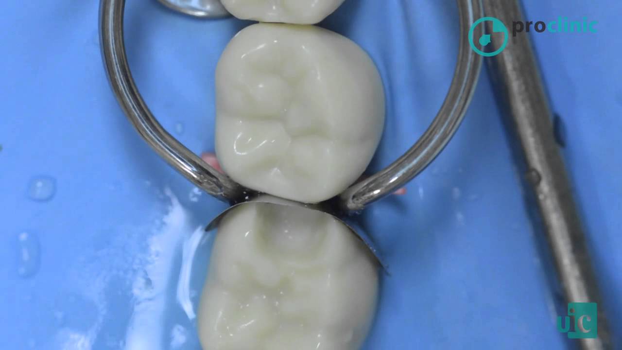 Cap. 9 - El material en odontología conservadora
