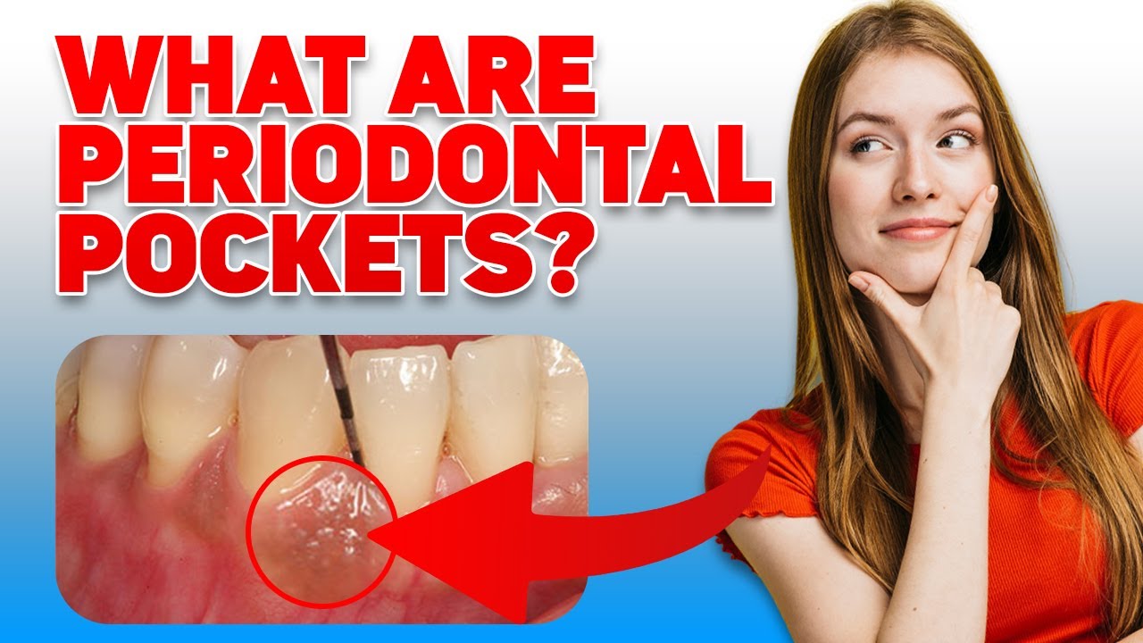 What Are Periodontal Pockets? 🦷🔍