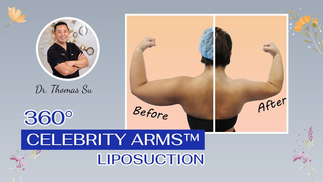 The Ultimate Arm Makeover | Full 360&deg; Liposuction Transformation by Dr. Thomas Su | Tampa, Florida
