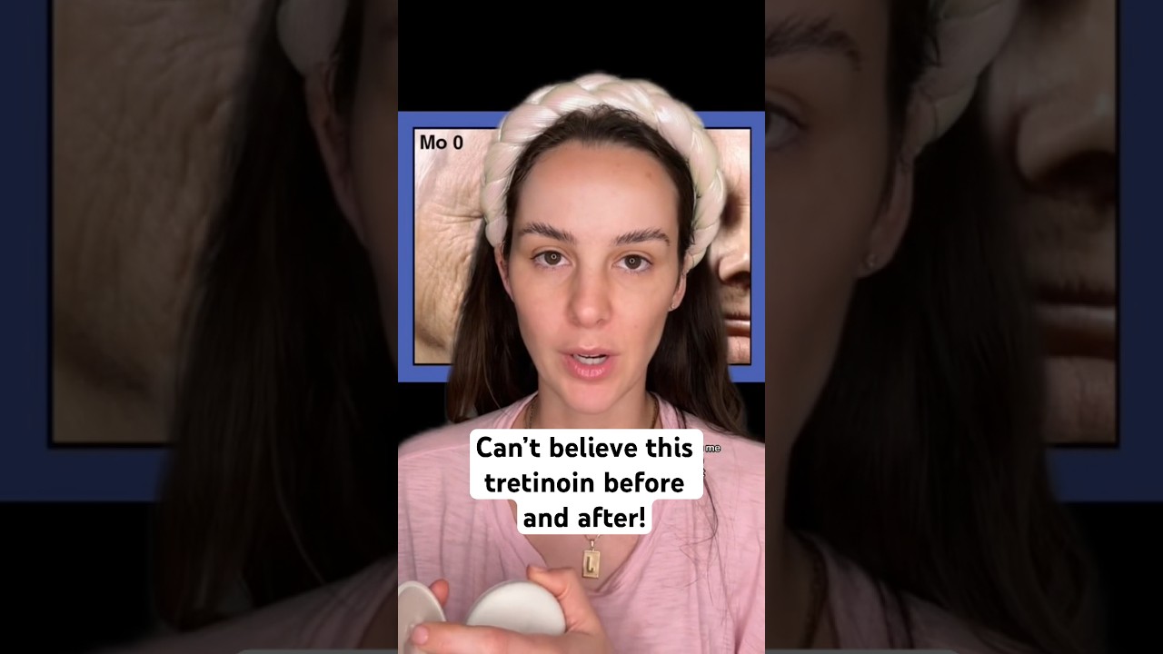 This tretinoin before and after is insane! #shorts #tretinoin