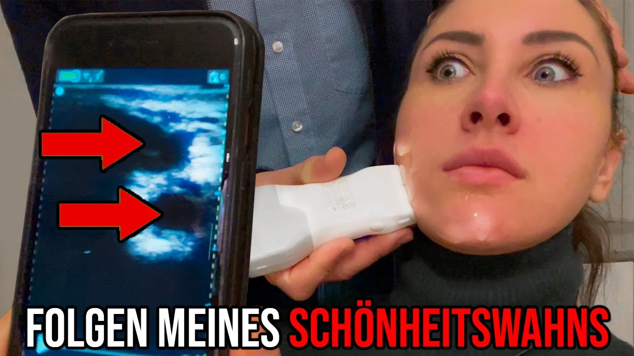 Das haben 8 Jahre Hyaluronsäure mit meinem Gesicht gemacht. Die Folgen!