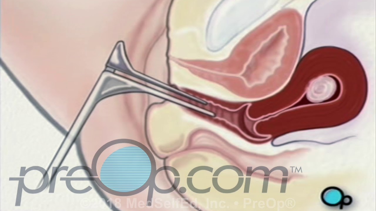 Vaginal Fibroid Removal Myomectomy Surgery &bull; PreOp Patient Education