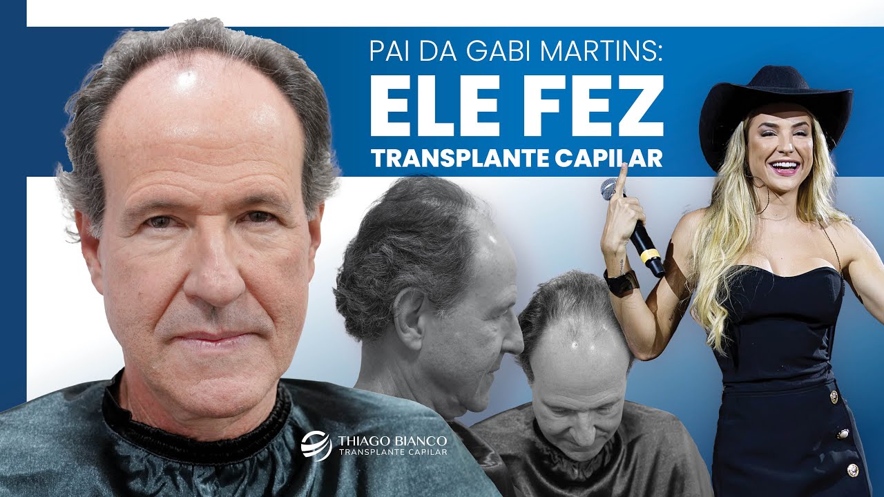 Pai da Gabi Martins fez transplante capilar: veja detalhes da cirurgia | Dr. Thiago Bianco