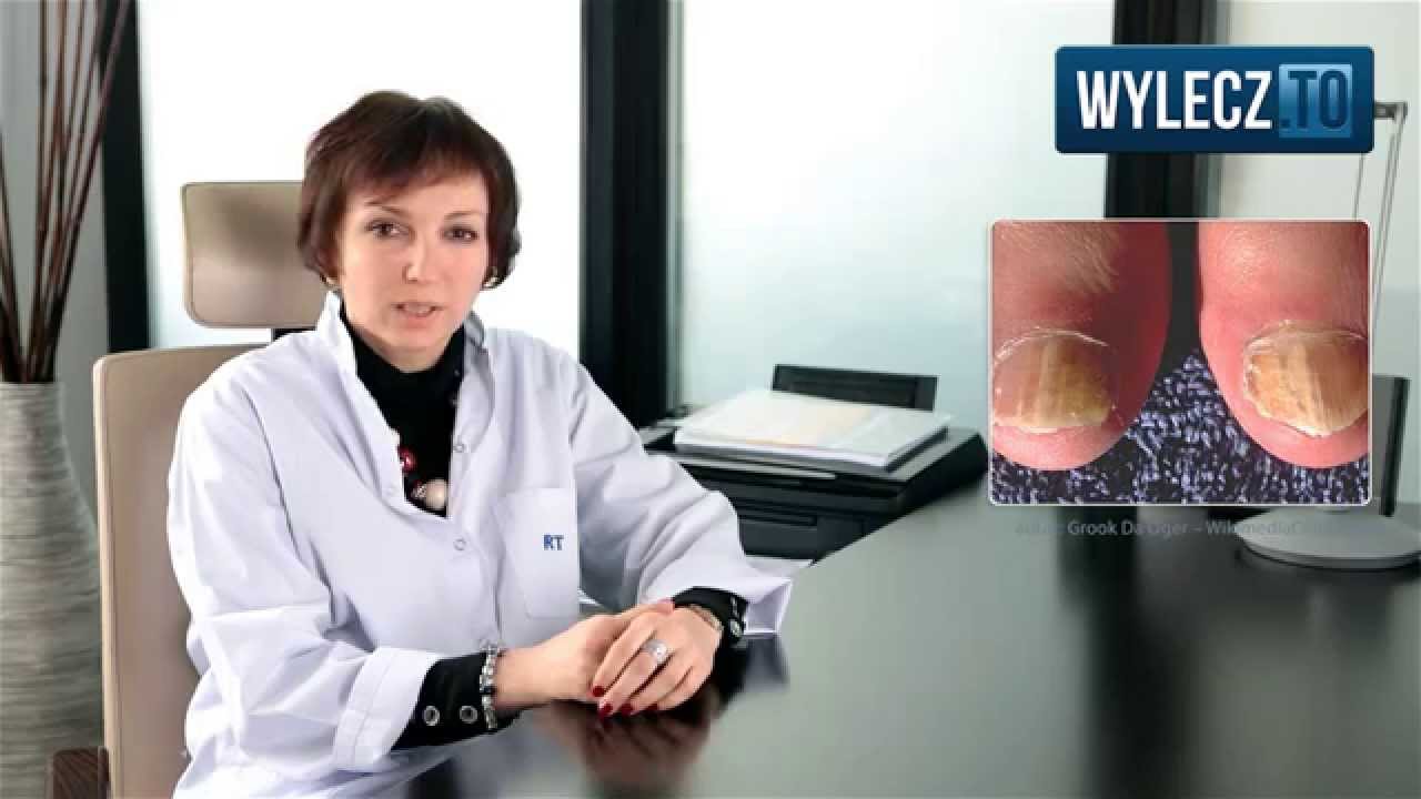 Grzybica paznokci