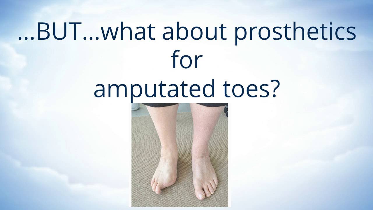 Toe Amputations and Orthotics