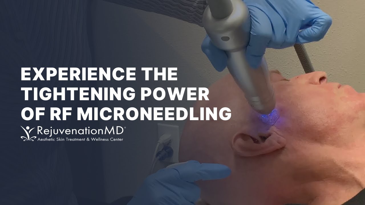 Unleash the Lifting Power of RF Microneedling with Scarlet SRF