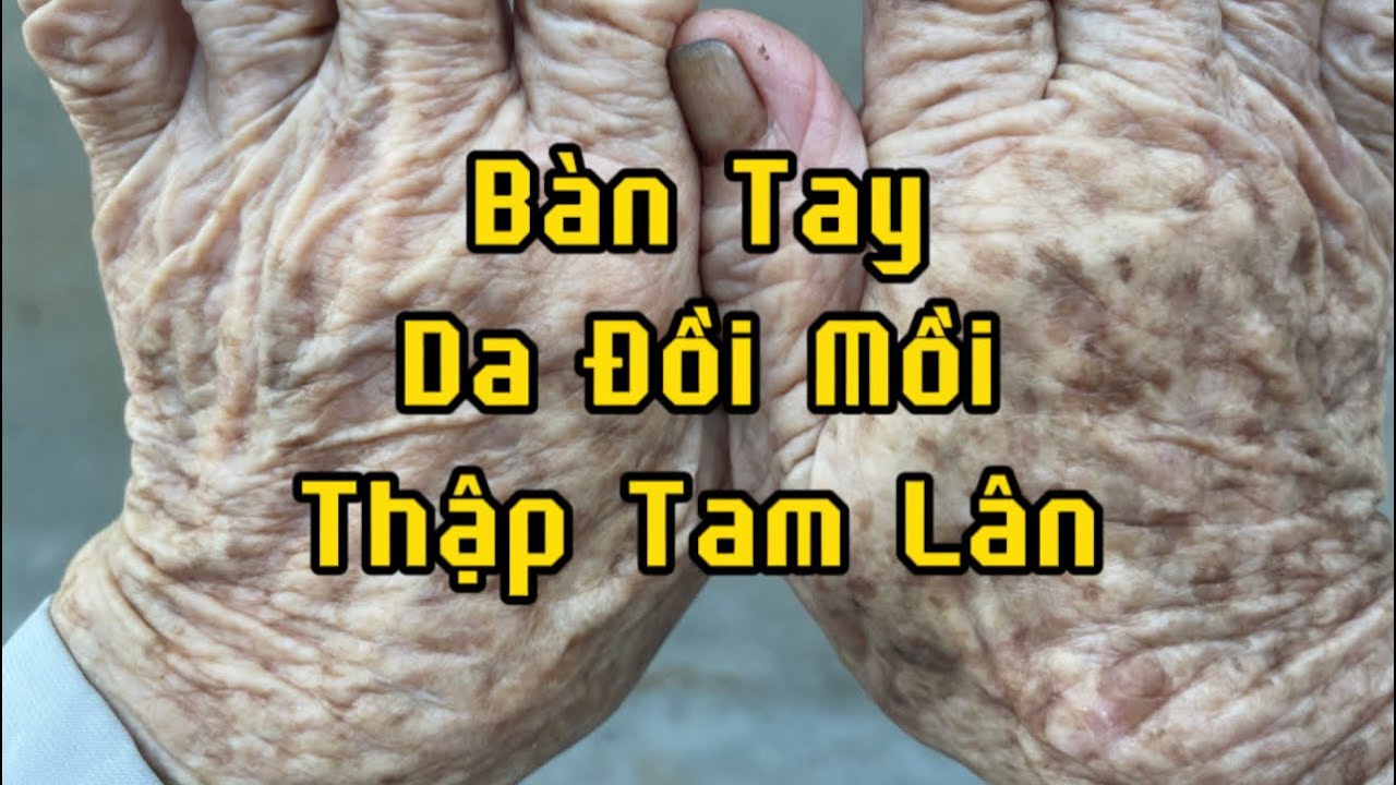 Bí ẩn về người có bàn tay da Đồi Mồi hay còn gọi là bàn tay Thập Tam Lân @tuphuthandien