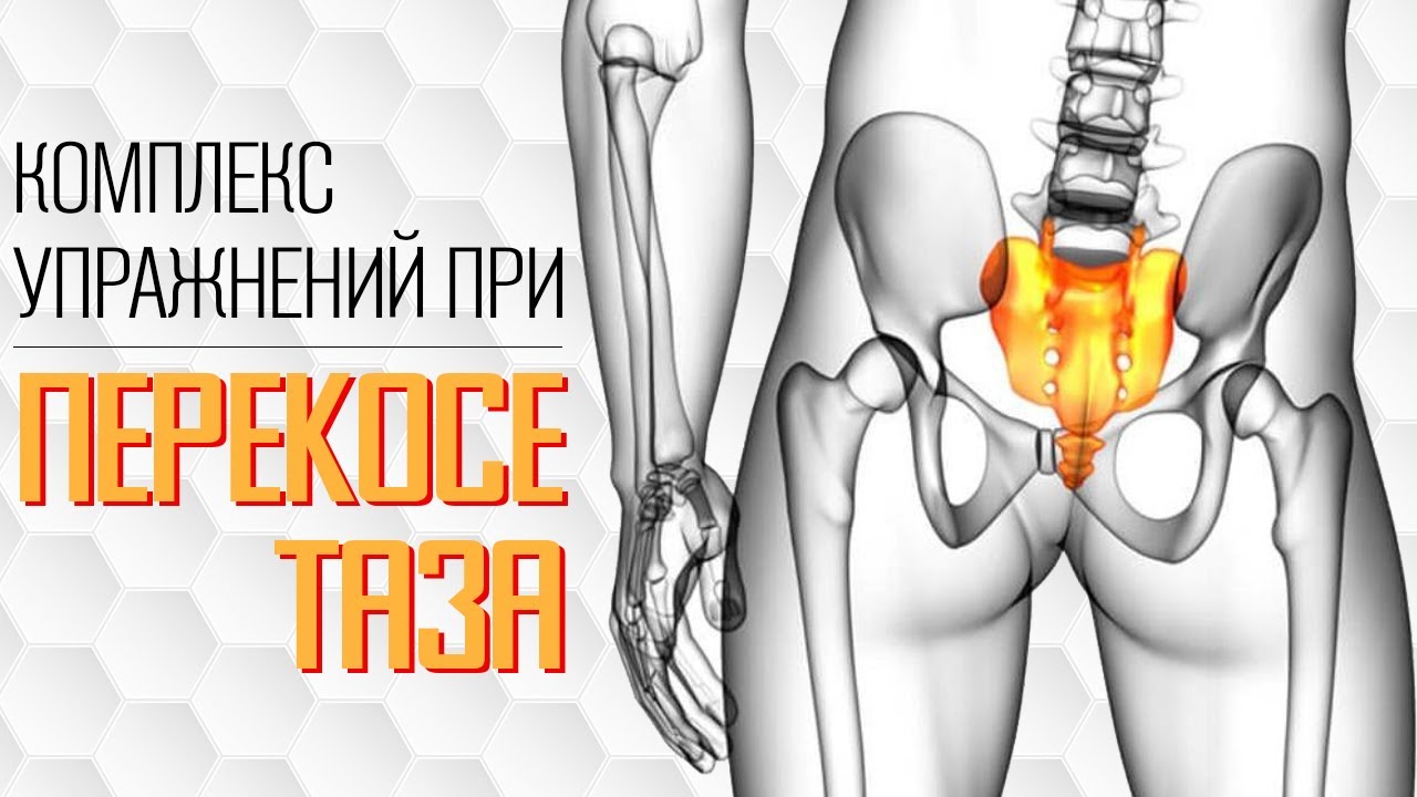 Комплекс упражнений при перекосе таза. Делаем правильный мышечный баланс.