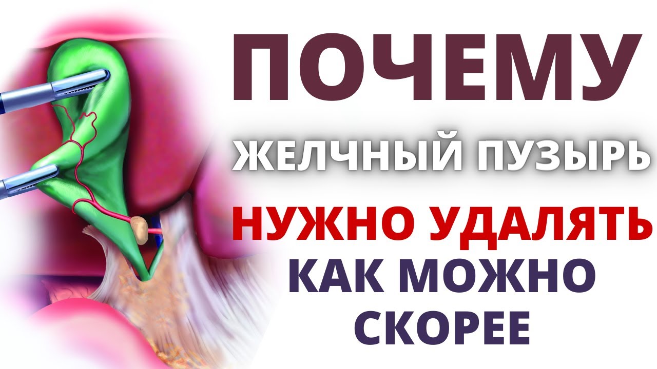 Почему нужно удалять желчный пузырь как можно скорее! Нашли камень в желчном пузыре - что делать?