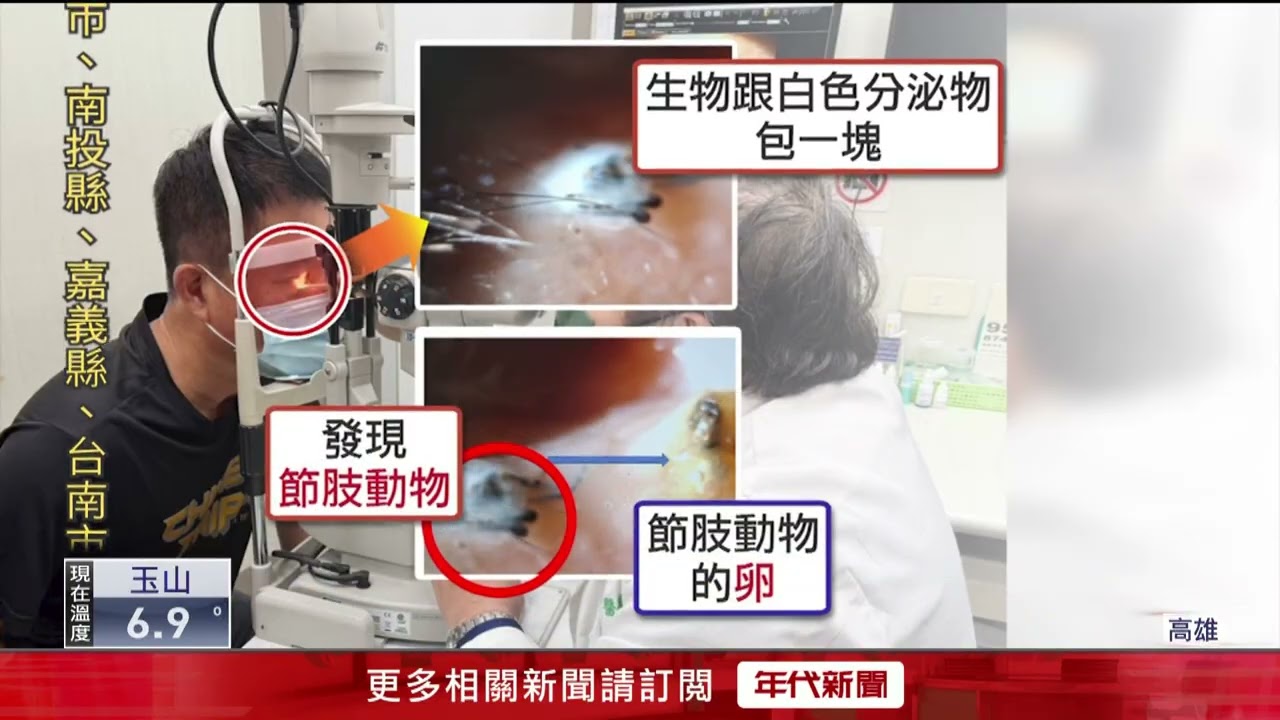 嚇！ 70歲阿北午睡後右眼劇痛　竟是「喇牙」鑽眼竄