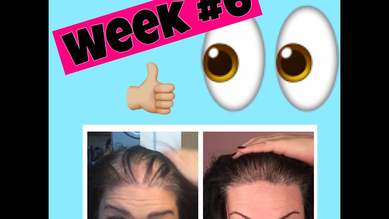 Hair Regrowth week#6 YOU WON'T BELIEVE