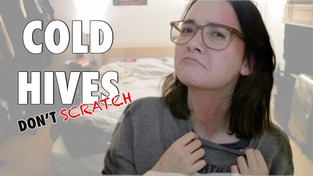 Itchy Itchy Urticaria aka. Cold Hives | ASHA ETC