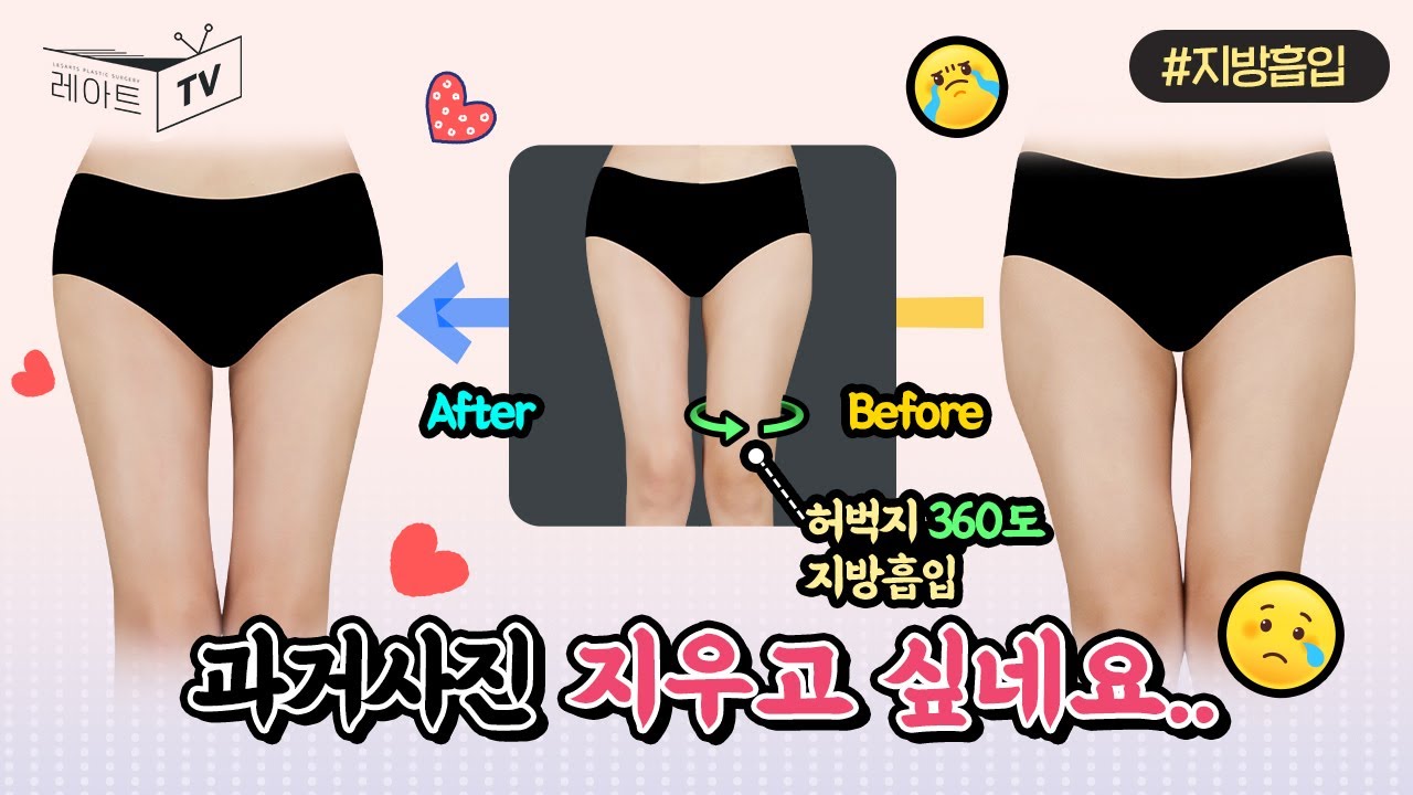 [허벅지지방흡입] 과거사진 지워주세요.. 이게 나일리 없잖아!🤔[레아트성형외과]