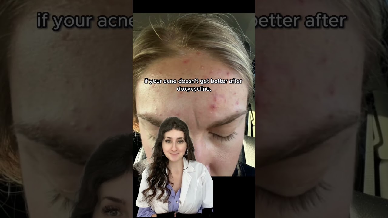 Doxycycline for Acne (Why It's NOT Working) #acne #shorts