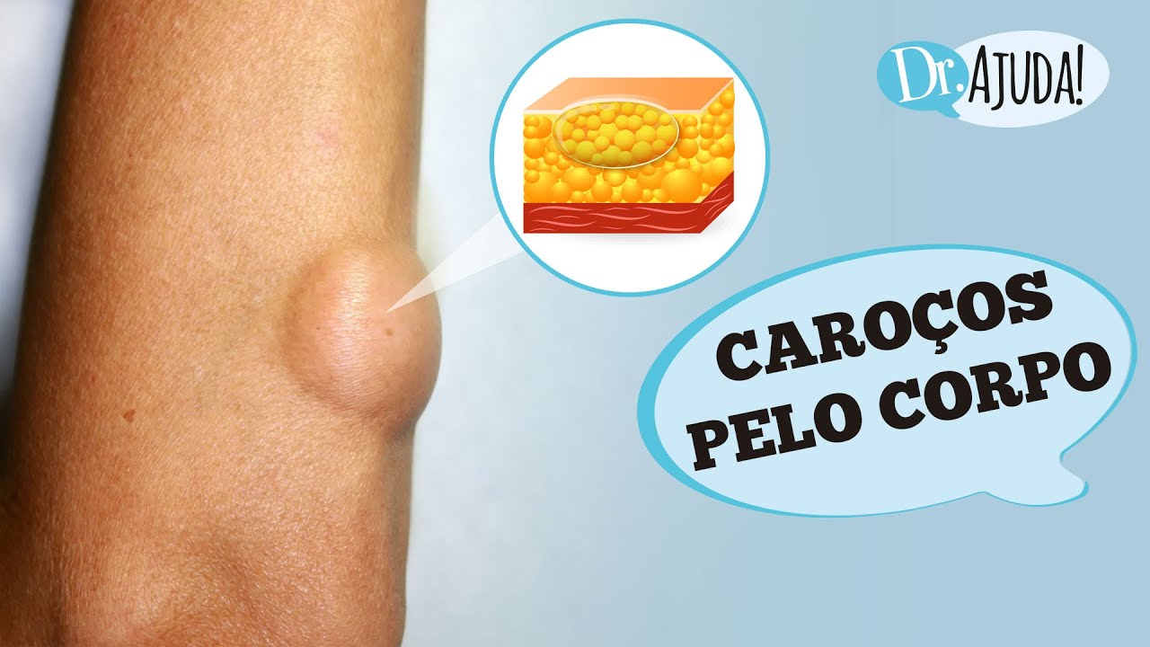 CARO&Ccedil;OS DE GORDURA NA PELE E LIPOMA: O QUE S&Atilde;O? O QUE REPARAR?