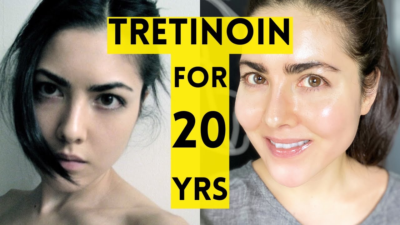 20 Year Results of Using Tretinoin