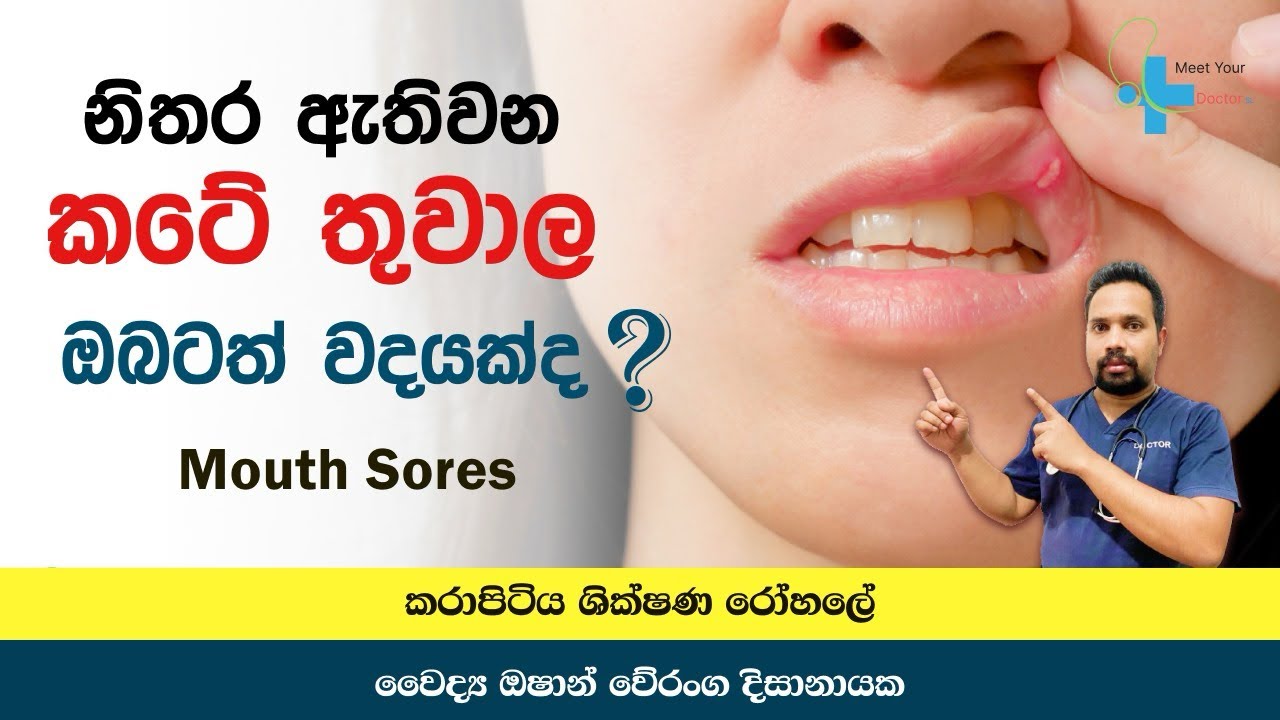 නිතර වද දෙන කටේ තුවාල හා එවාට ප්&zwj;රතිකාර ක්&zwj;රම | Mouth Sores Treatments | Mouth Ulcers #mouthsores