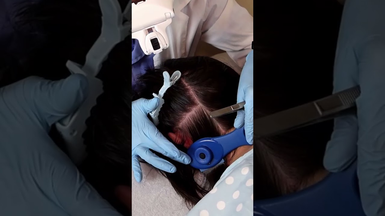 ASMR School Nurse LICE Check on Scalp and Neck | Removal with a Comb and Tweezers #asmr #short